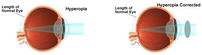 visual of Long-Sightedness (Hypermetropia)